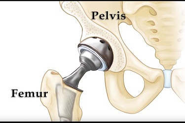 Best Hip Replacement Surgeon in India, Best Hospital For Hip Replacement Surgery In India , Best Doctor For Hip Replacement Surgery In India, Cost Of Hip Replacement Surgery In India , Hip Fracture Surgery in India